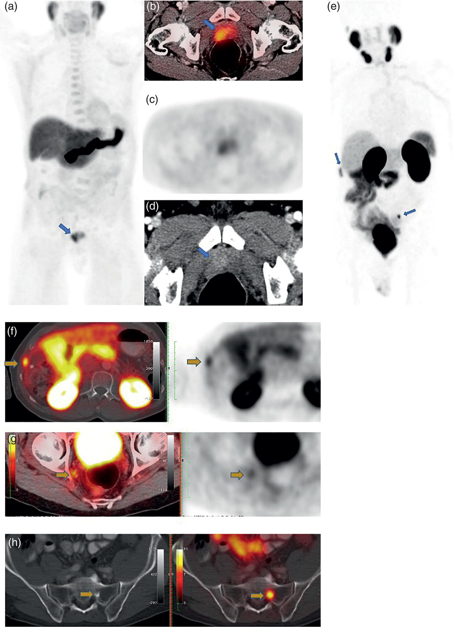 Schematic illustration of 68-year-old male with high-risk (Gleason score 4 + 4) prostate adenocarcinoma was referred for initial staging with 18F-fluciclovine PET/CT as shown in (A) coronal MIP, (B) fused axial PET/CT, and the corresponding (C) axial PET and (D) axial CT scan.