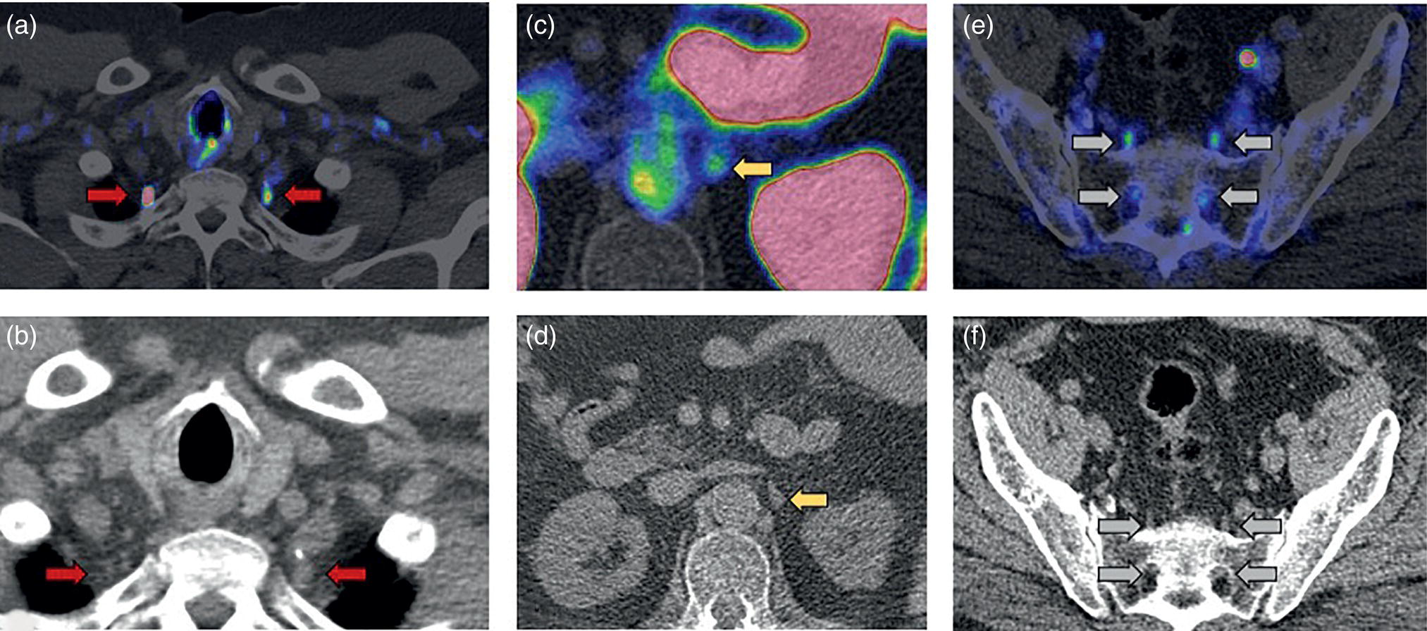 Schematic illustration of fused 18F-DCFPyL PET/CT scan and corresponding CT in three different patients show physiologic PSMA expression in the cervicothoracic stellate ganglia (A and B, red arrows), celiac ganglion (C and D, yellow arrows), and sacral ganglia (E and F, gray arrows).