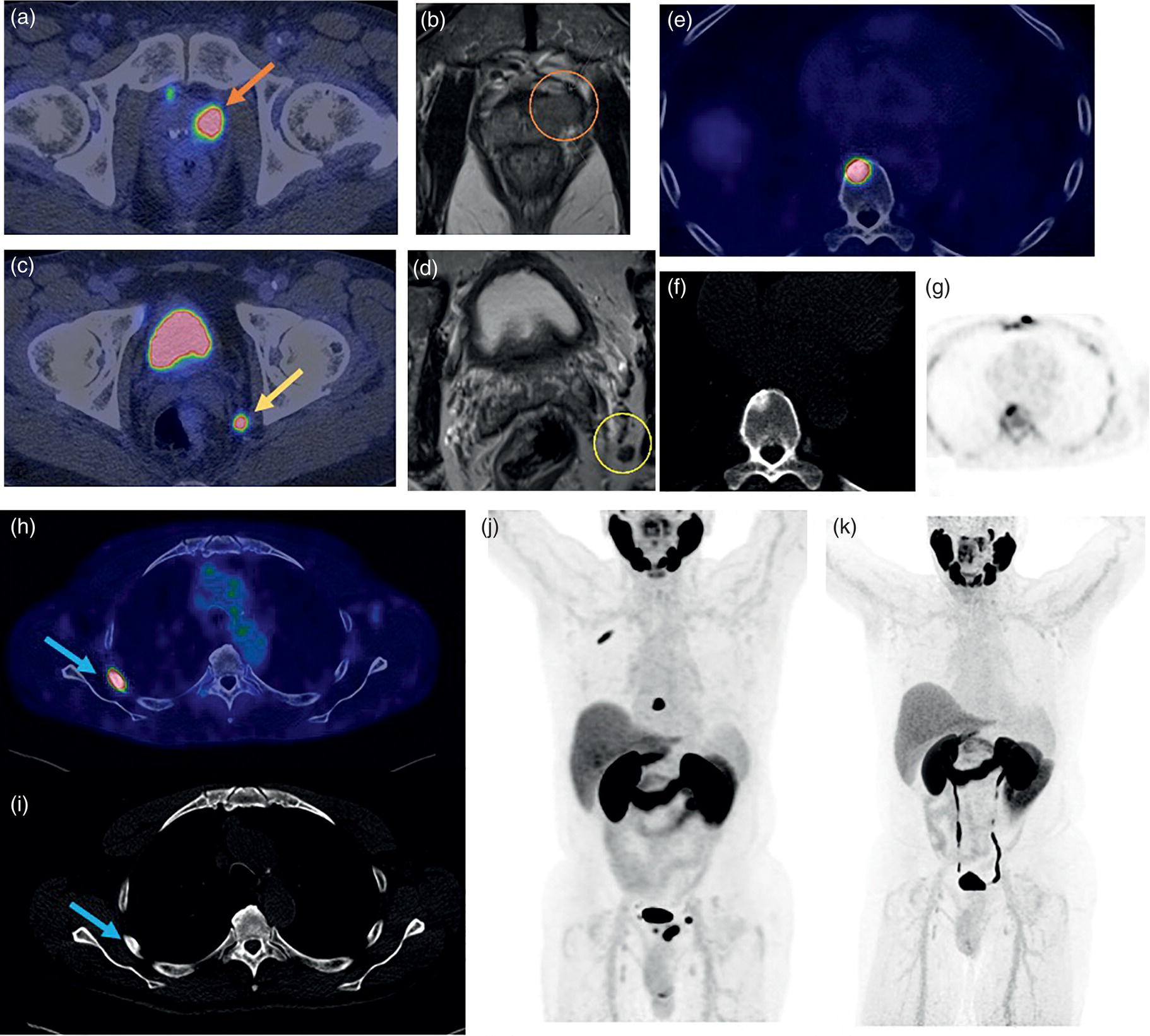 Schematic illustration of 73-year-old male with castration-resistant oligometastatic prostate cancer, referred for restaging.