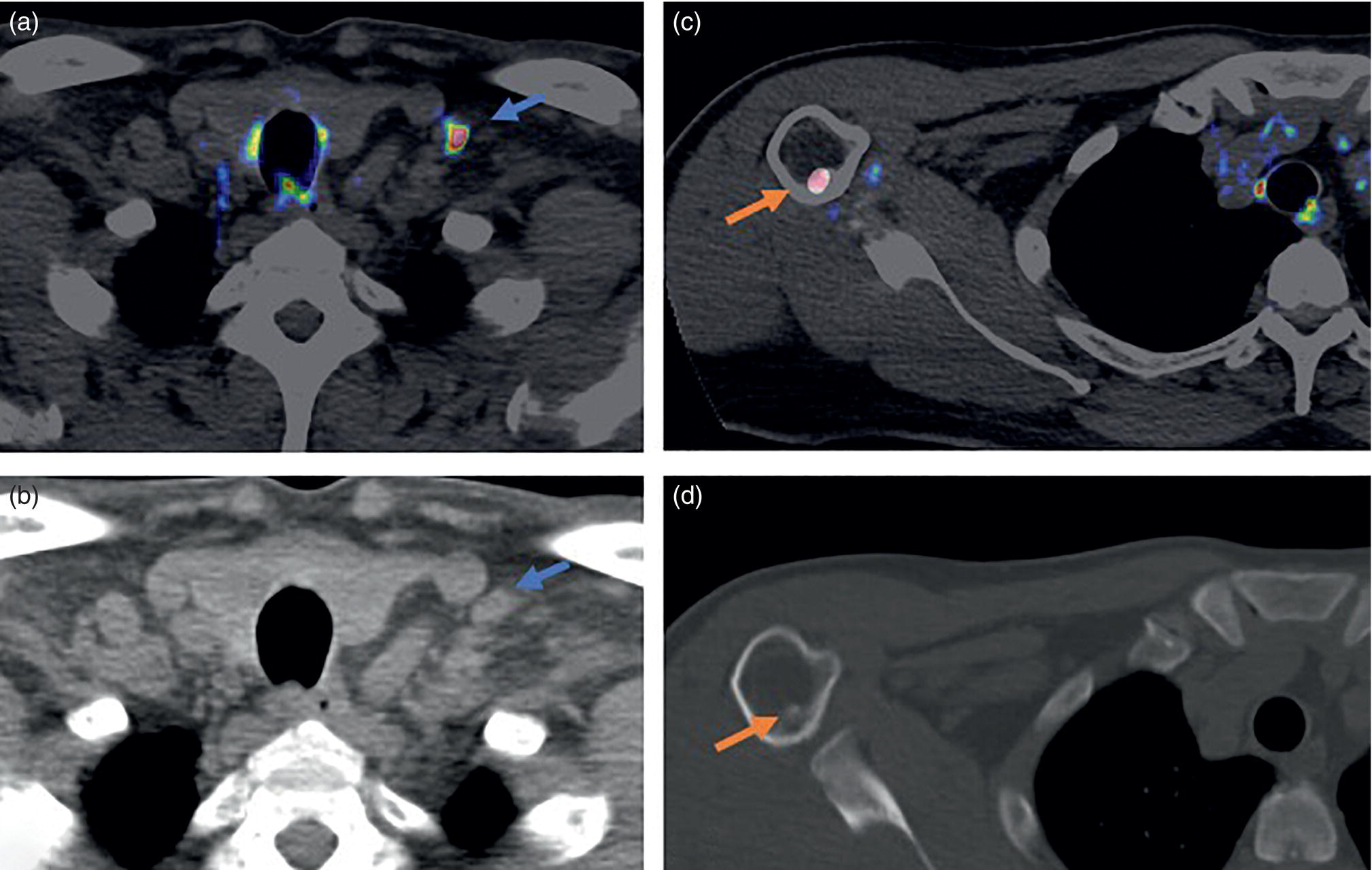 Schematic illustration of 64-year-old male with history of high-risk prostate cancer status post radiotherapy and androgen deprivation therapy presented with biochemical recurrence (serum PSA 5.26 ng/mL).