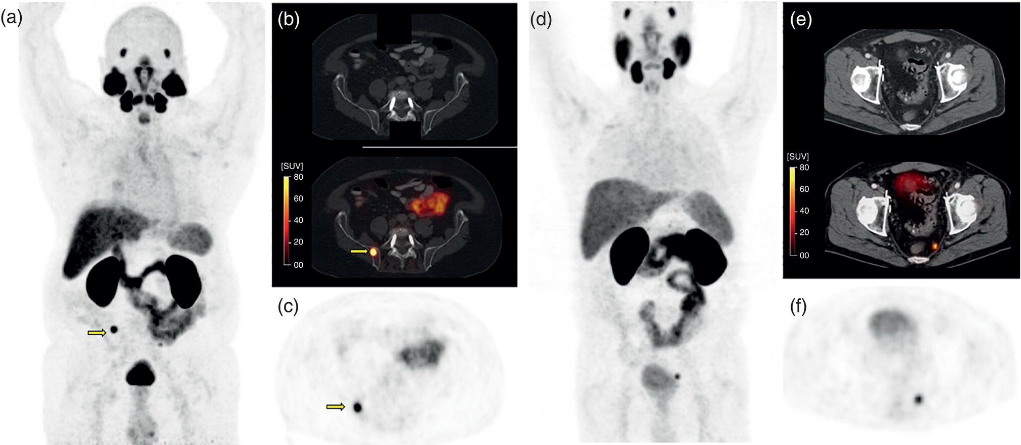 Schematic illustration of 68Ga-PSMA-11 image in two different patients acquired for localization of biochemical recurrence.