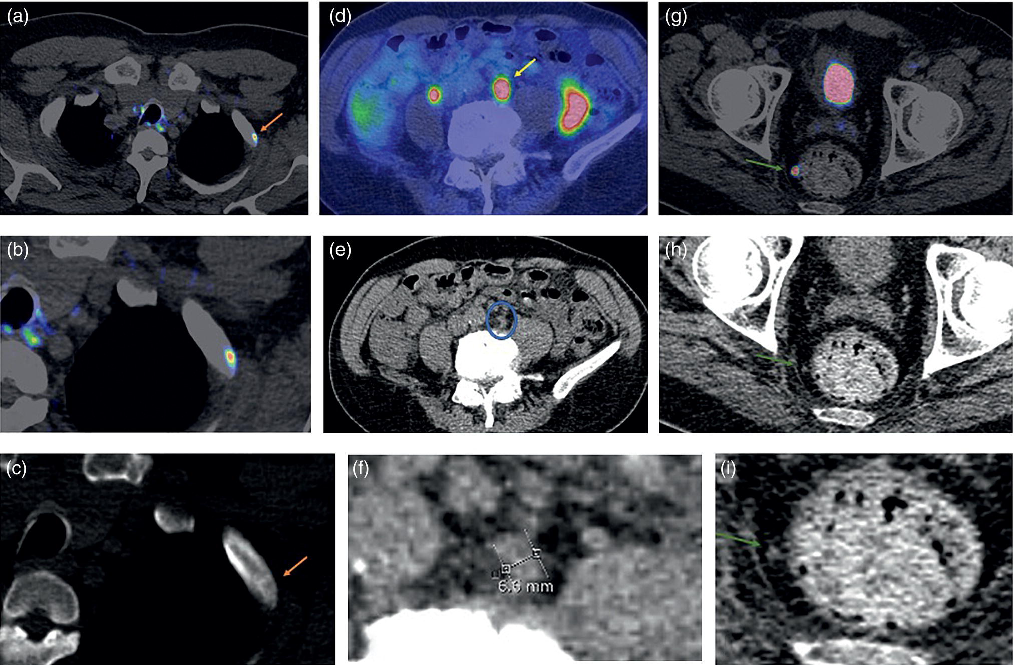 Schematic illustration of 18F-DCFPyL PSMA PET/CT in three different patients shows PSMA-positive metastatic lesions which are not positive by CT criteria only.