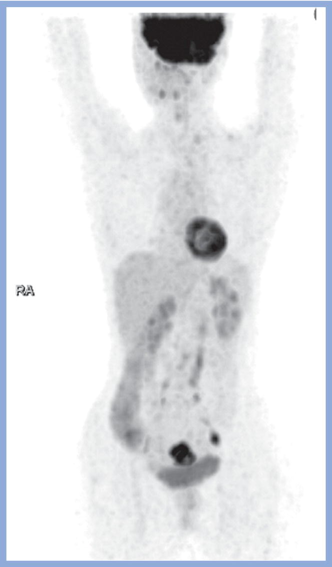 Schematic illustration of FDG PET MIP image of a 61-year-old female patient presenting with a suspected uterine mass (left). FDG PET/CT scan showed intensely hypermetabolic uterine mass lesion suggestive of primary tumor (as shown in image A below) as well as hypermetabolic borderline sized left para-iliac and retroperitoneal lymph nodes (arrows in image B) and left supraclavicular lymph node (arrows in image C), which were confirmed to be metastasis.