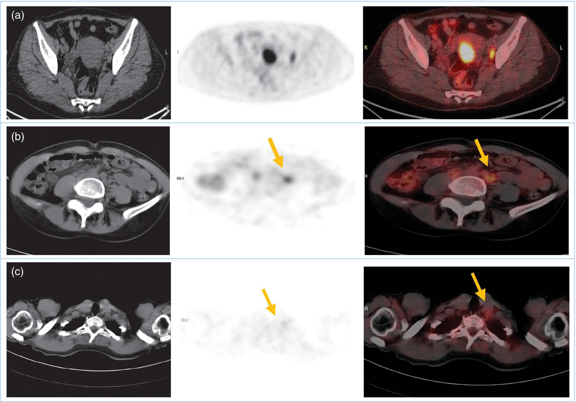 Schematic illustration of FDG PET MIP image of a 61-year-old female patient presenting with a suspected uterine mass (left). FDG PET/CT scan showed intensely hypermetabolic uterine mass lesion suggestive of primary tumor (as shown in image A below) as well as hypermetabolic borderline sized left para-iliac and retroperitoneal lymph nodes (arrows in image B) and left supraclavicular lymph node (arrows in image C), which were confirmed to be metastasis.