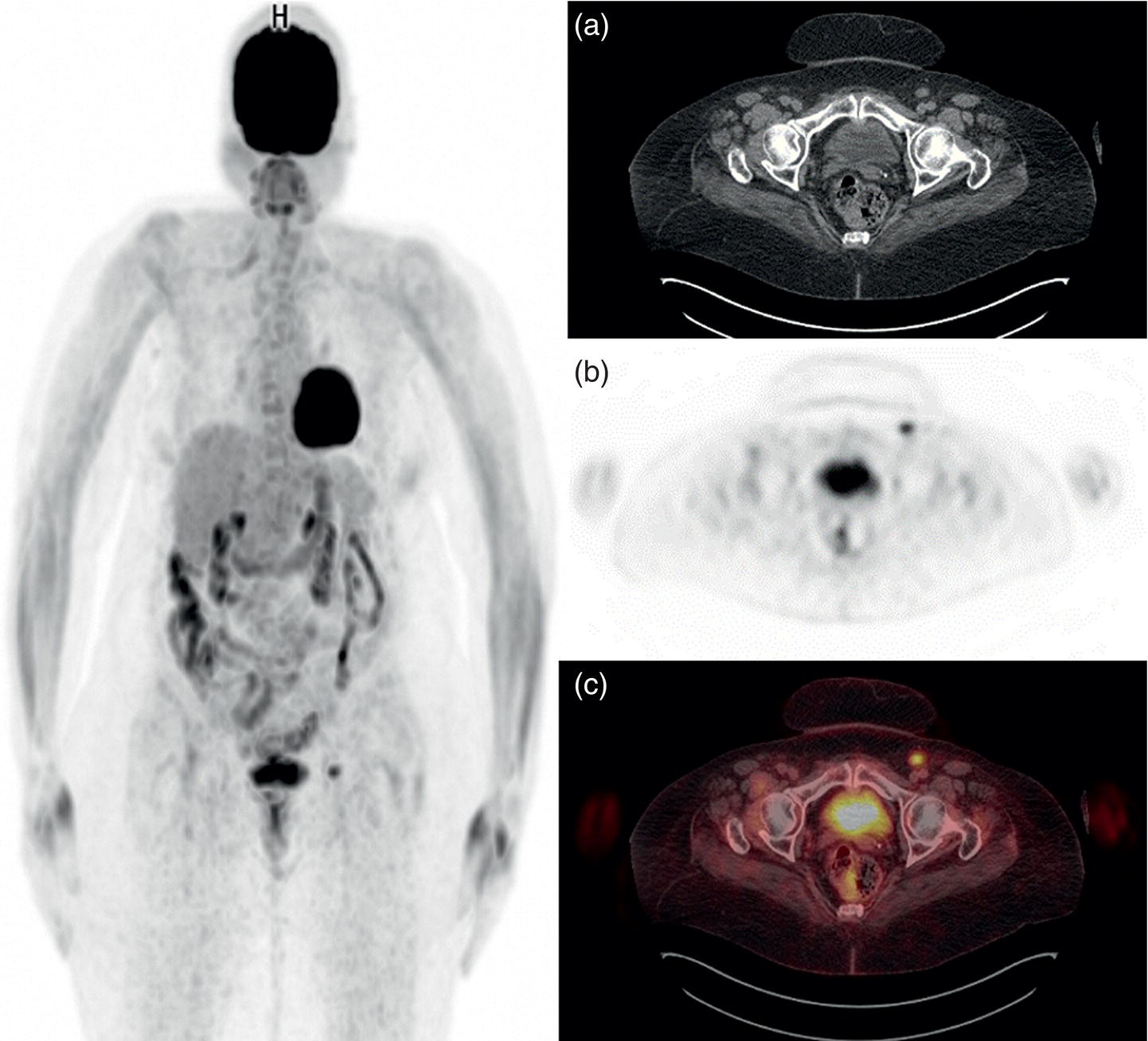 Schematic illustration of a 70-year-old woman who proved to have endometrial cancer after total abdominal hysterectomy and bilateral salpingo-oophorectomy.