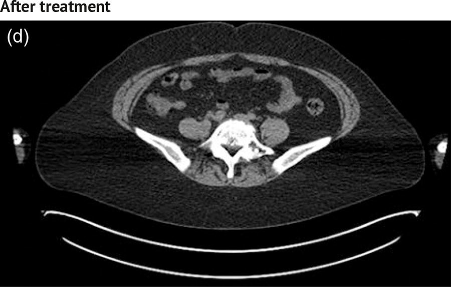 Schematic illustration of a before treatment photograph of a 53-year-old female endometrial cancer patient.