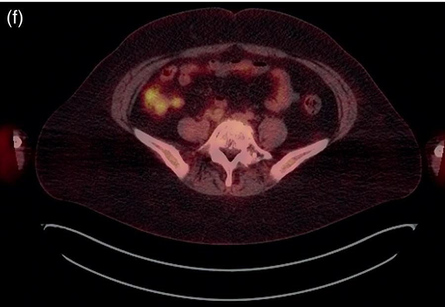 Schematic illustration of a before treatment photograph of a 53-year-old female endometrial cancer patient.