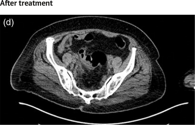 Schematic illustration of the before treatment PET image of a 66-year-old female patient with endometrial cancer.