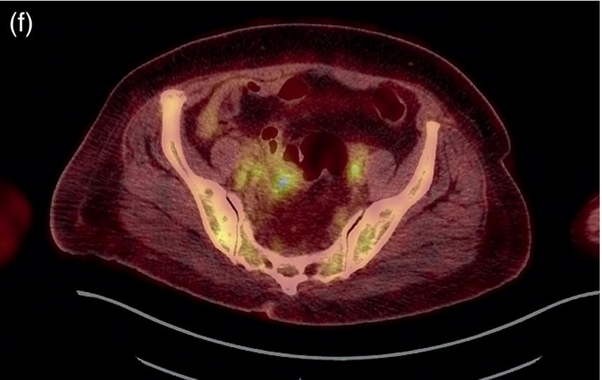 Schematic illustration of the before treatment PET image of a 66-year-old female patient with endometrial cancer.
