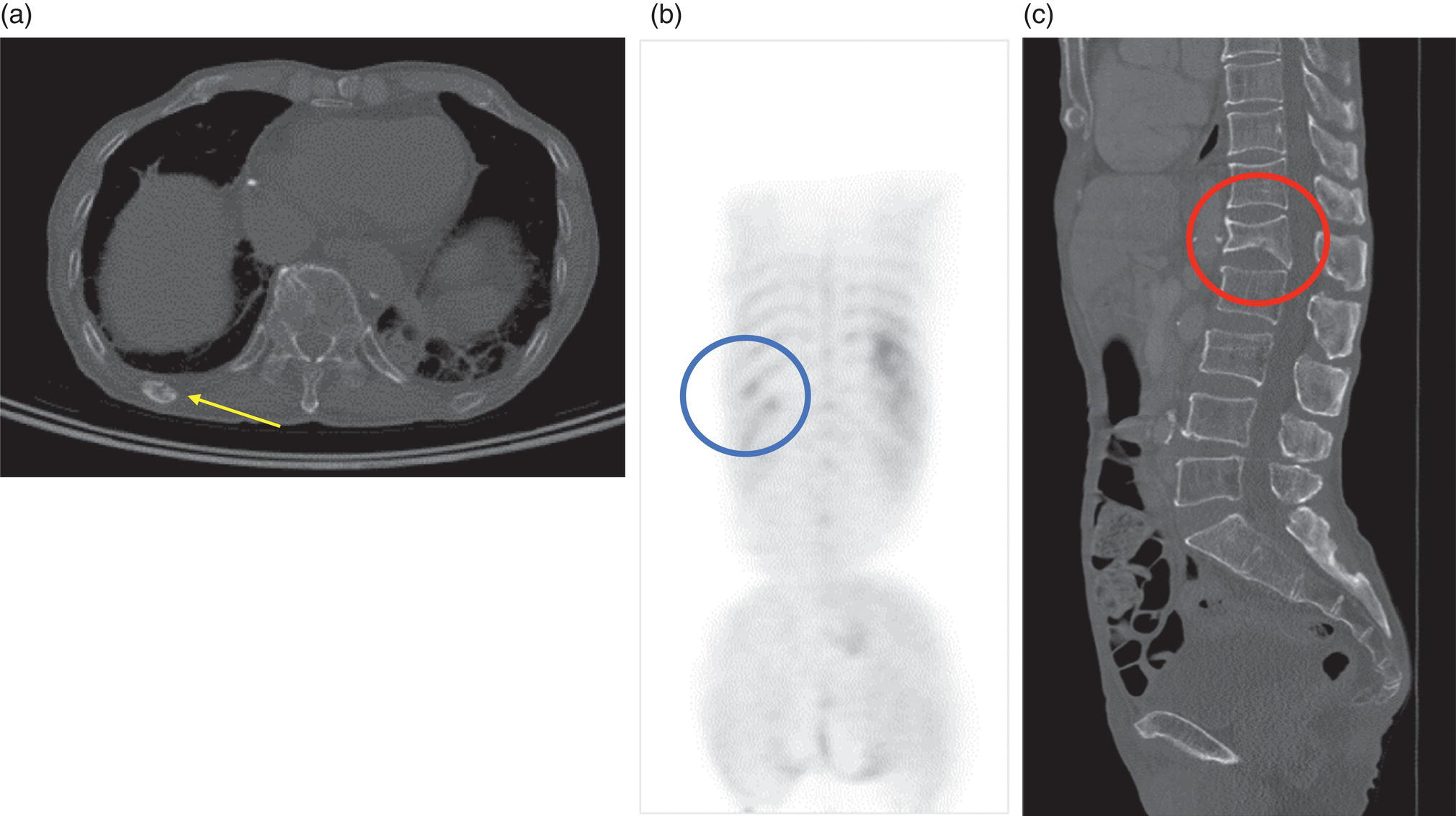 Schematic illustration of 90-year-old female with diffuse large B cell lymphoma.