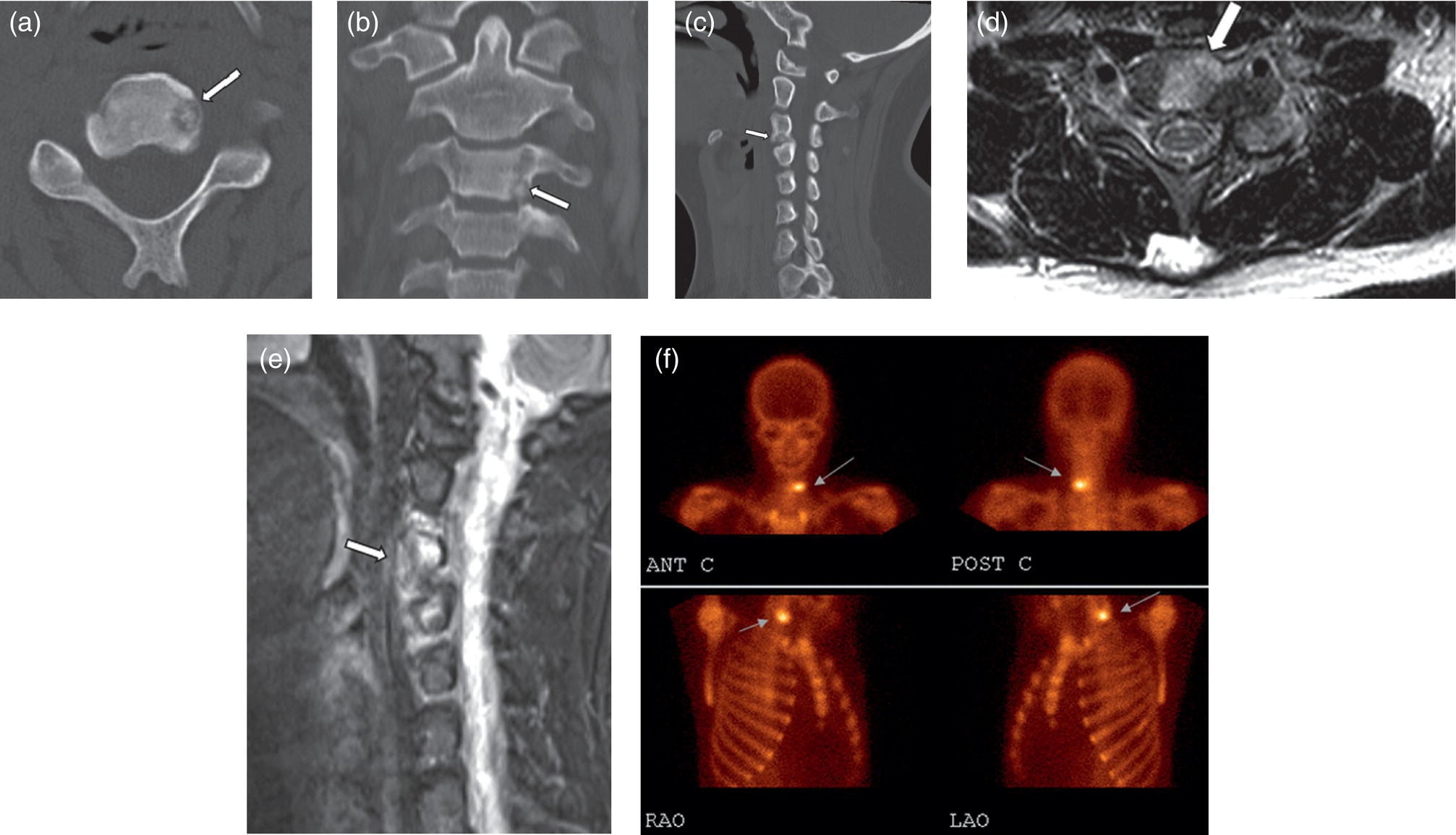 Schematic illustration of axial (A), coronal (B), and sagittal (C) CT images of an osteoid osteoma patient showing a hypodense osteolytic area in the left posterior of the third cervical vertebral body (A–C, arrows) accompanying a central nidus and sclerotic rim, typical for osteoid osteoma.