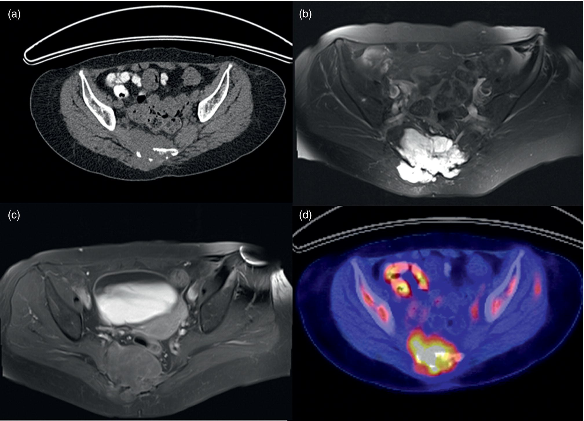 Schematic illustration of CT scan (A), axial MRI (B, C), and PET/CT (D) of a 64-year-old woman with a history of sacral mass and diagnosis of chordoma.