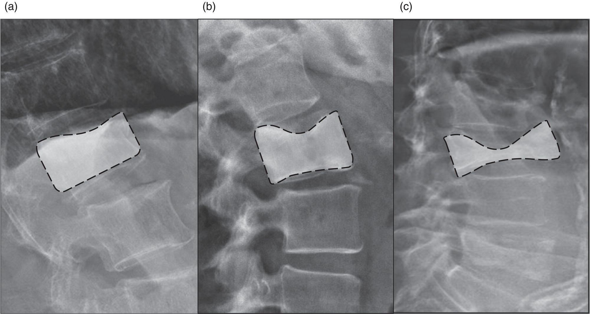 Schematic illustration of genant's semiquantitative grading system for evaluation of vertebral fractures based on maximum reduction of the vertebral height.