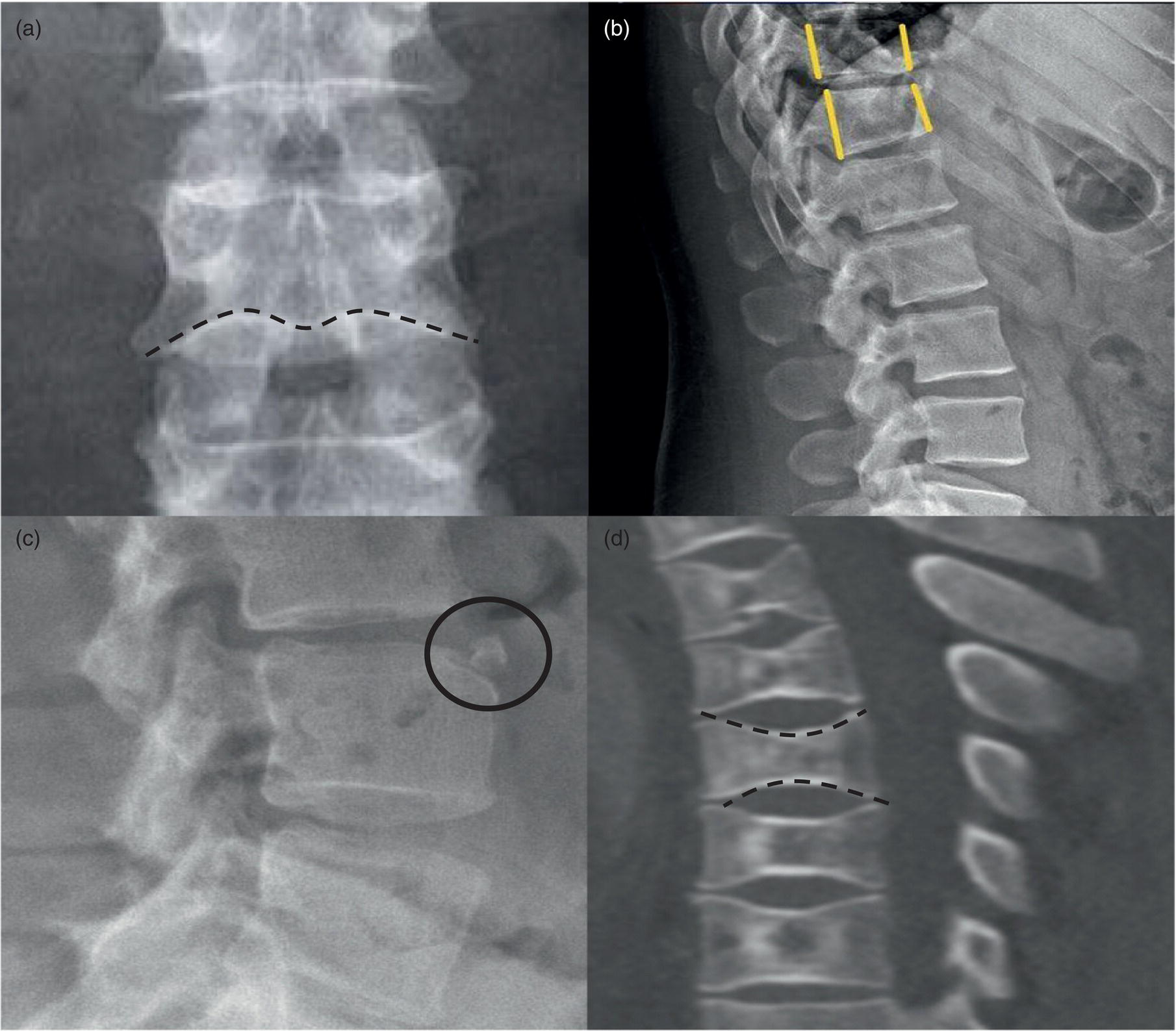 Schematic illustration of examples of normal variants and mimickers of vertebral fractures on radiographs.