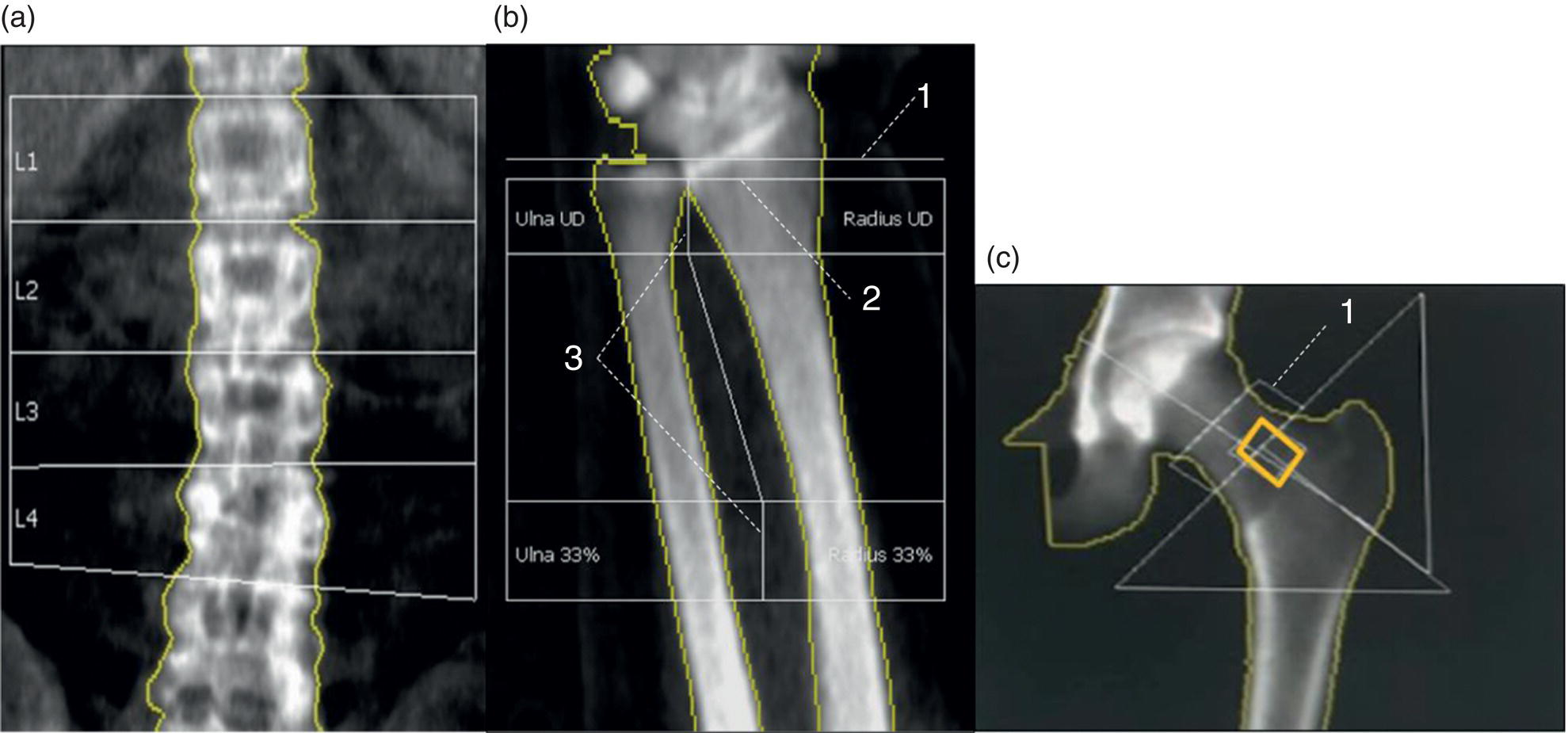 Schematic illustration of examples of optimally obtained DXA studies.