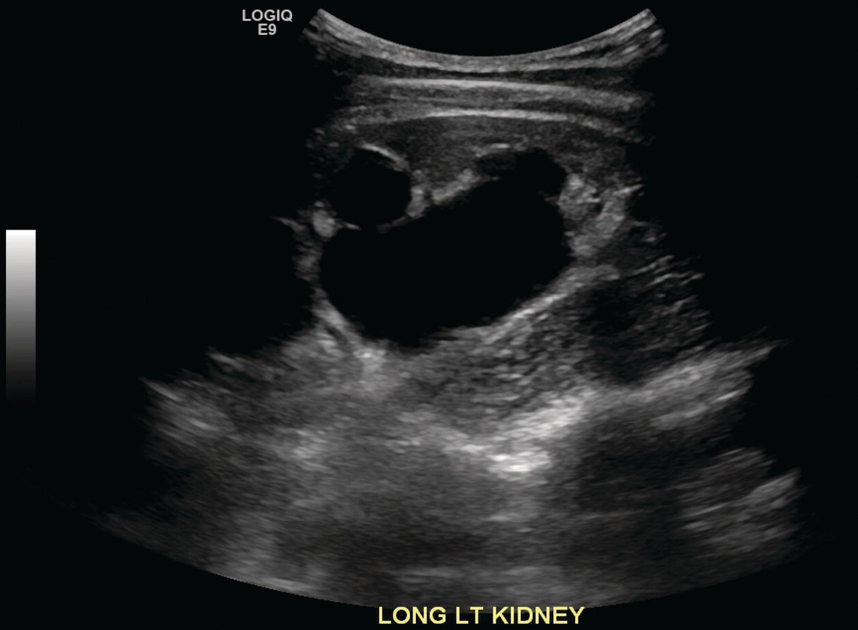 Schematic illustration of severe hydronephrosis.