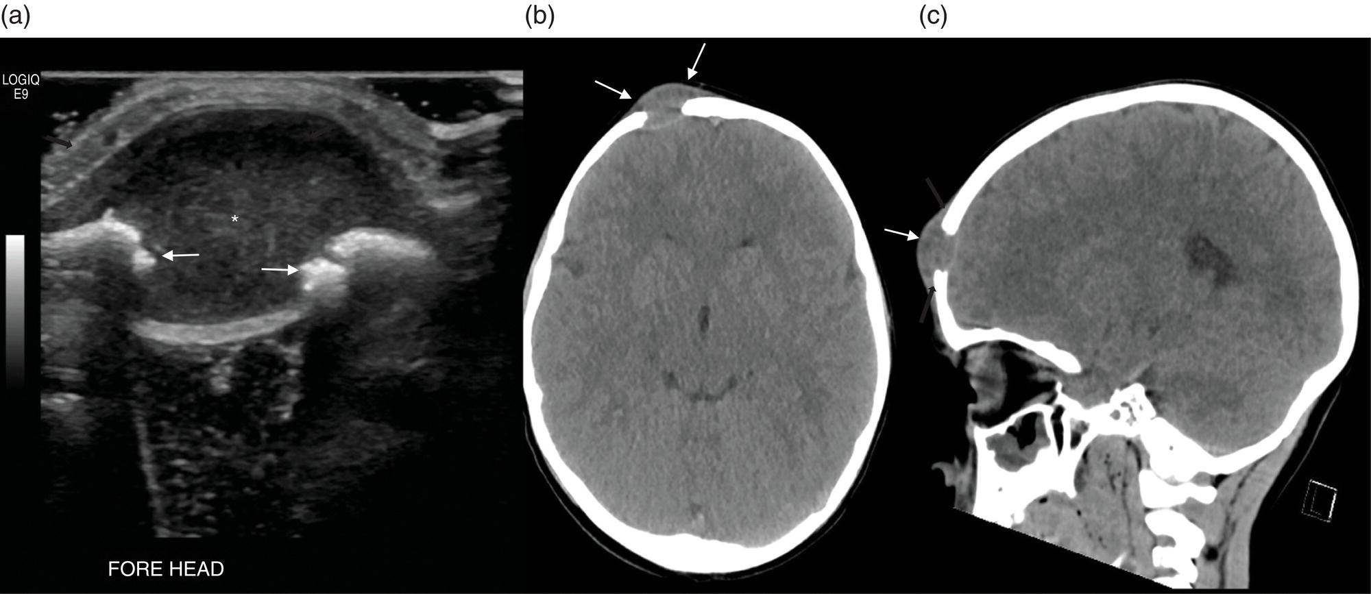 Schematic illustration of (a) 5-year-old male with right forehead swelling. (b) Axial CT image of the brain shows the frontal bone lesion with convex border (white arrows) filling the defect. (c) Sagittal CT of the brain demonstrating frontal bone lesion with mass (white arrow) filling the defect.