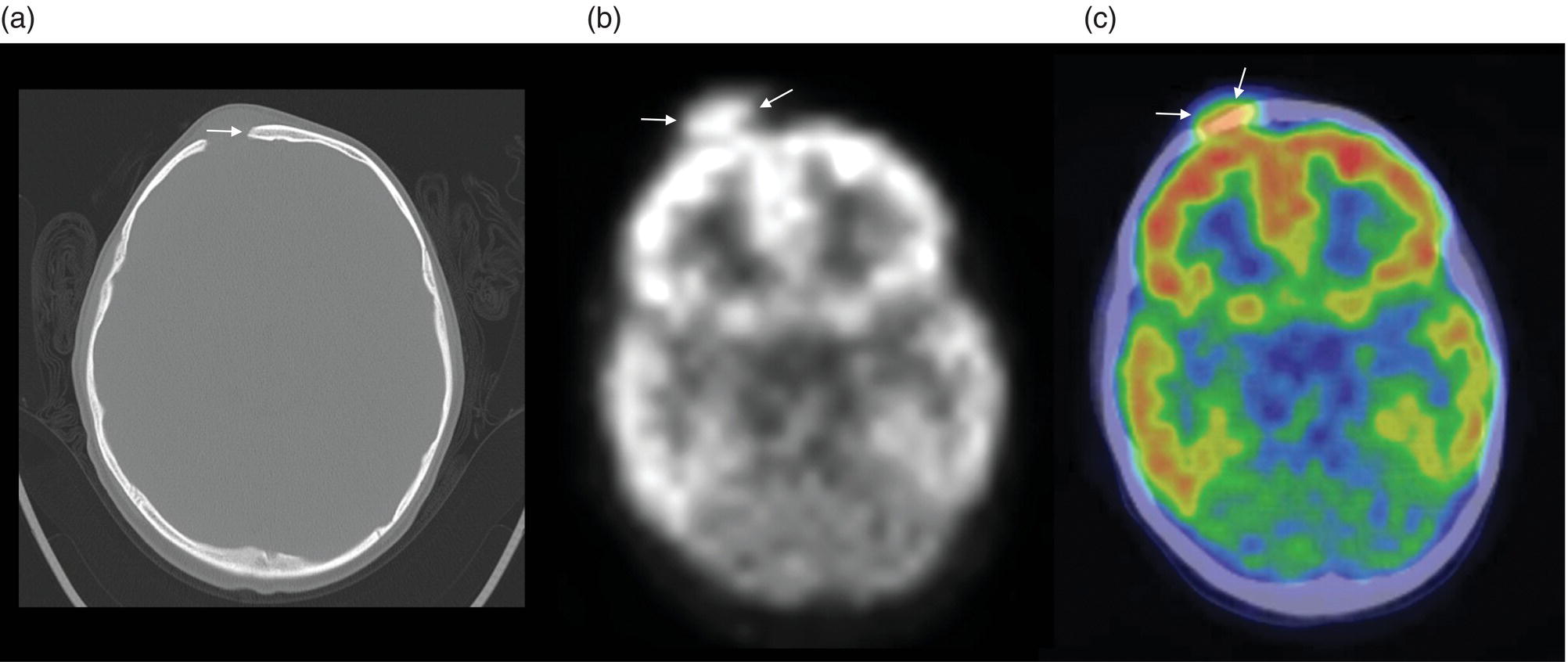 Schematic illustration of (a) 5-year-old male with right forehead swelling. (b) Axial 18FDG PET images with attenuation correction of the brain show intense uptake in the area of the frontal bone lesion (white arrows). (c) Fused axial PET-CT images of the brain demonstrating frontal bone lesion with mass with focal intense radiotracer uptake in the defect (white arrows). 