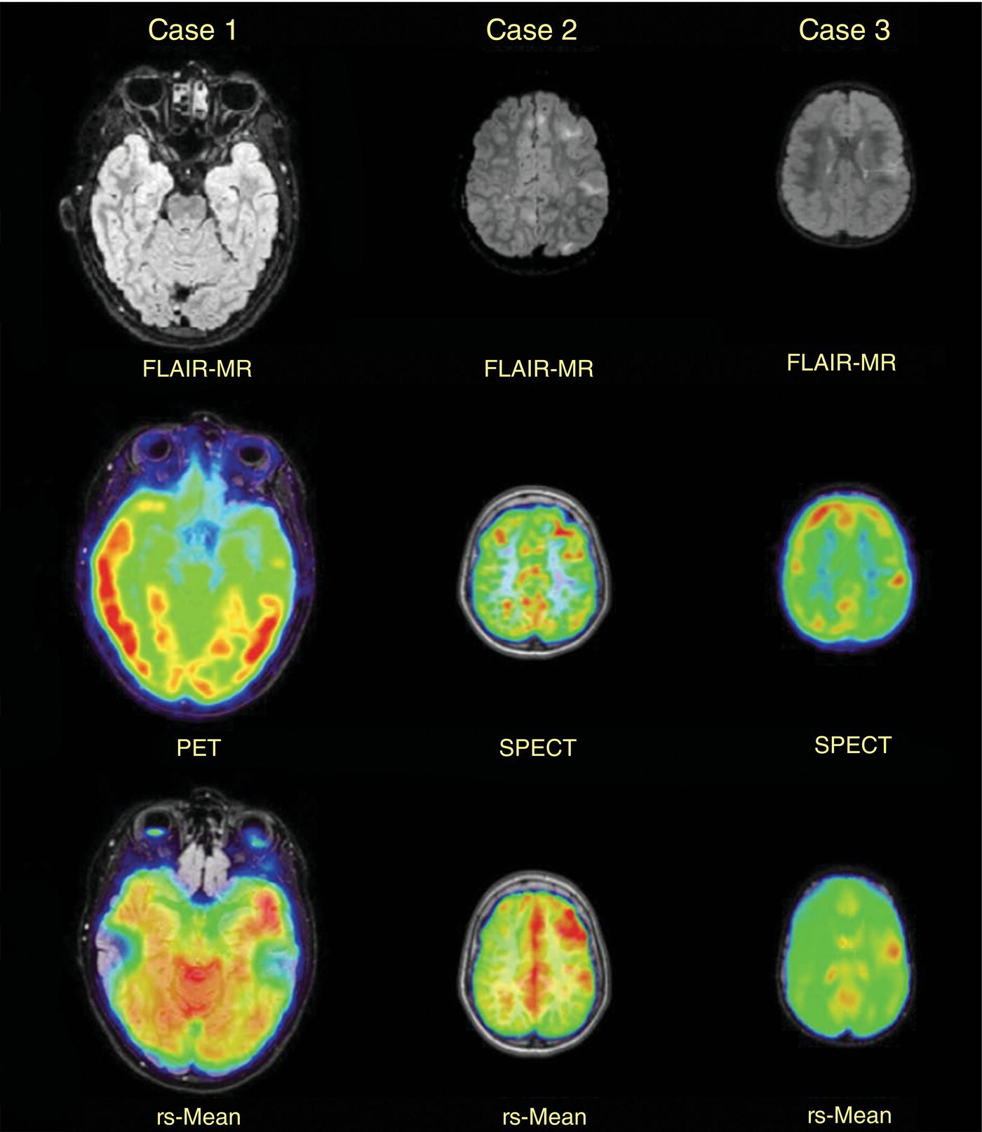 Schematic illustration of example of three patients who underwent evaluation with fMRI for retractable epilepsy (all images are axial in normal radiologic anatomical convention).