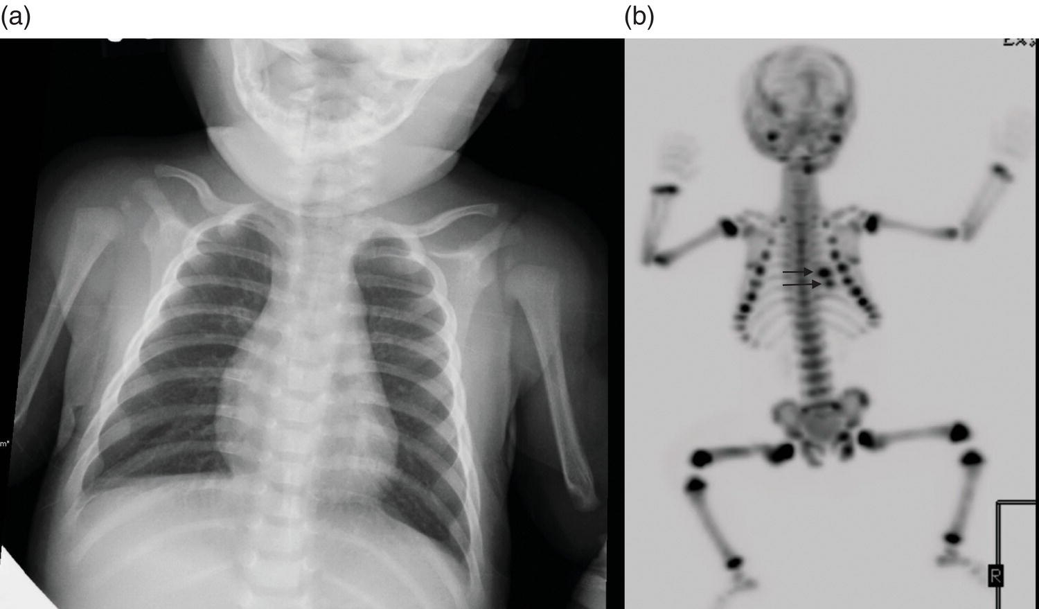 Schematic illustration of (a) 2-year-old male with suspected nonaccidental trauma. (b) 18F-NaF 3D Maximum intensity projection (MIP) bone scan showing focal intense radiotracer activity in the left posterior eighth and ninth ribs (black arrows) consistent with acute rib fractures.