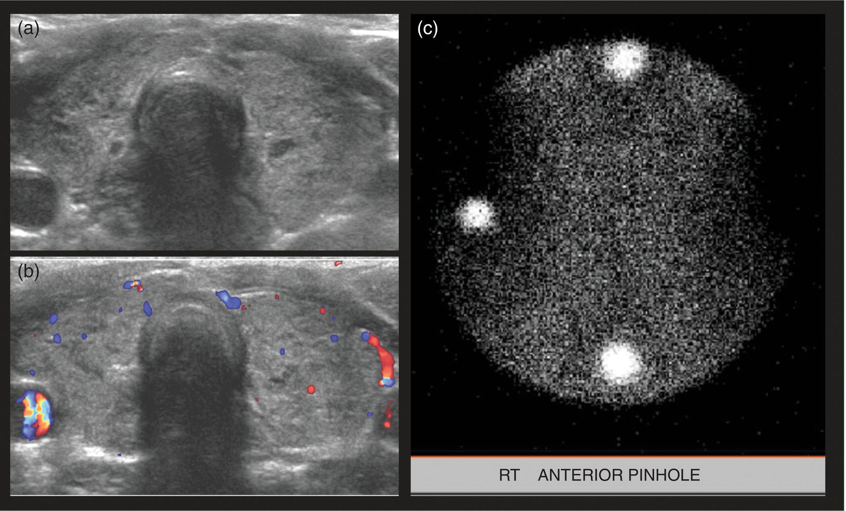 Schematic illustration of (a) 14-year-old female with Hashimoto's thyroiditis. (b) Color Doppler transverse US image shows decreased vascularity. (c) 99mTc scan shows no uptake in the nonfunctioning gland. Markers were placed at the right neck chin and sternal notch.