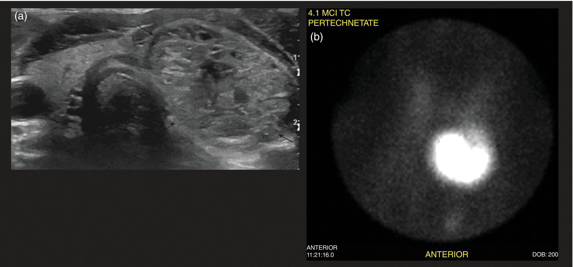 Schematic illustration of (a) 12-year-old female with a solitary hyperfunctioning autonomous nodule at the inferior left thyroid lobe. (b) 99mTc thyroid scintigraphy with pinhole collimator shows a large hyperfunctioning nodule (arrow) at the left lower suppressing the remainder of the gland.