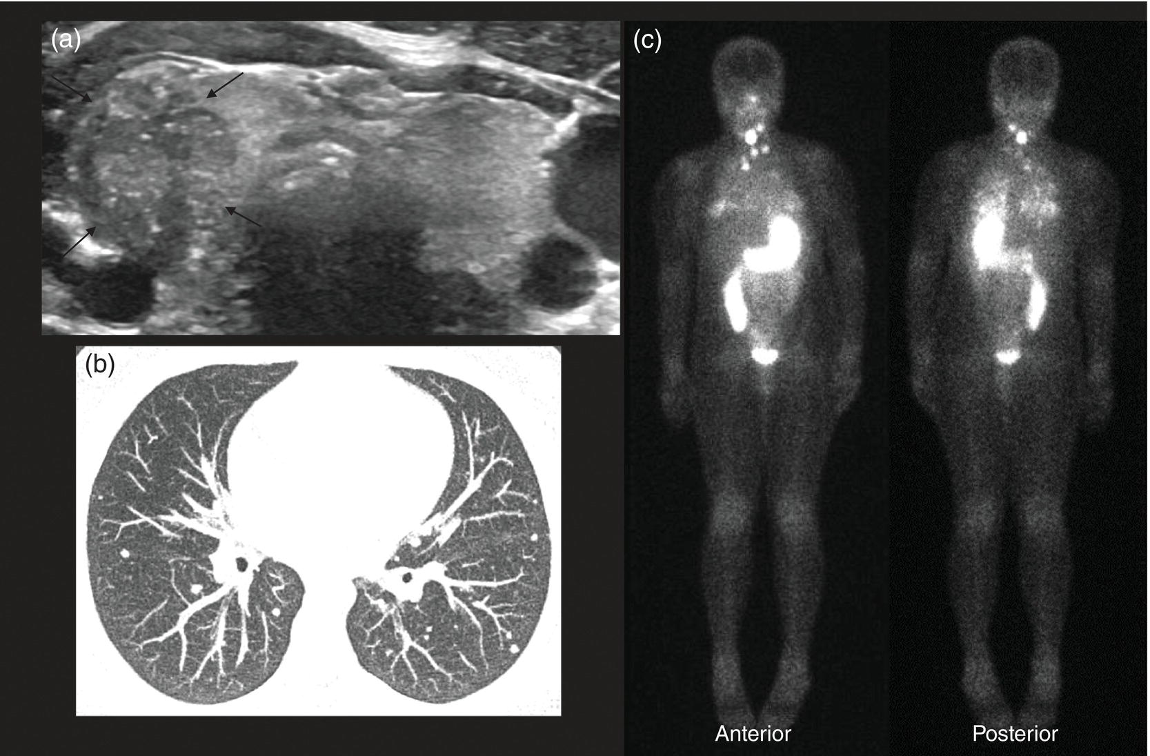 Schematic illustration of (a) 10-year-old female with papillary thyroid carcinoma diagnosed by FNA. (b) Chest CT (maximum intensity reconstruction) with numerous pulmonary metastatic nodules. (c) Staging 123I whole-body scan after total thyroidectomy shows residual and local metastatic lymph nodes in the neck as well as diffuse pulmonary metastases. 