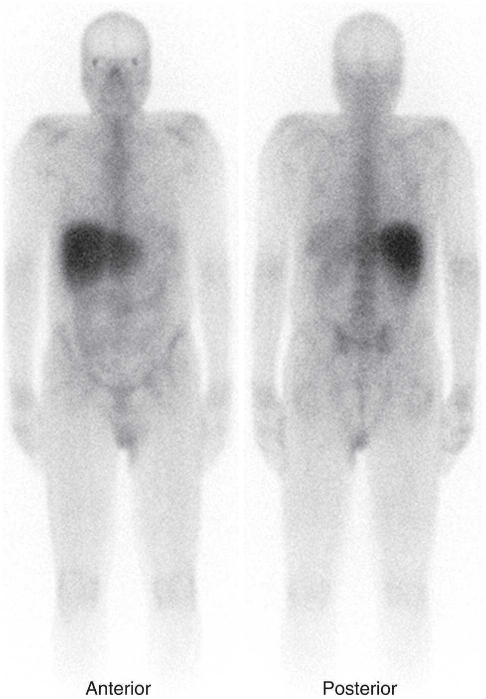 Schematic illustration of normal gallium-67 scan.