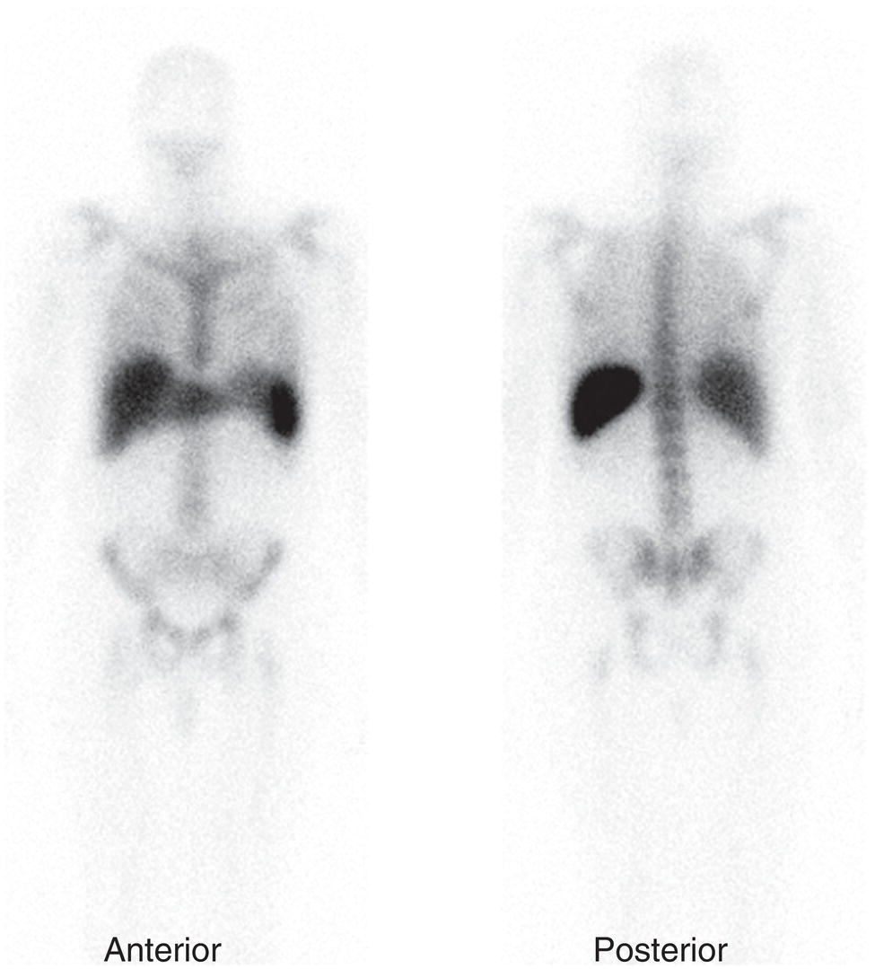 Schematic illustration of normal indium-111 labeled leukocyte scan.