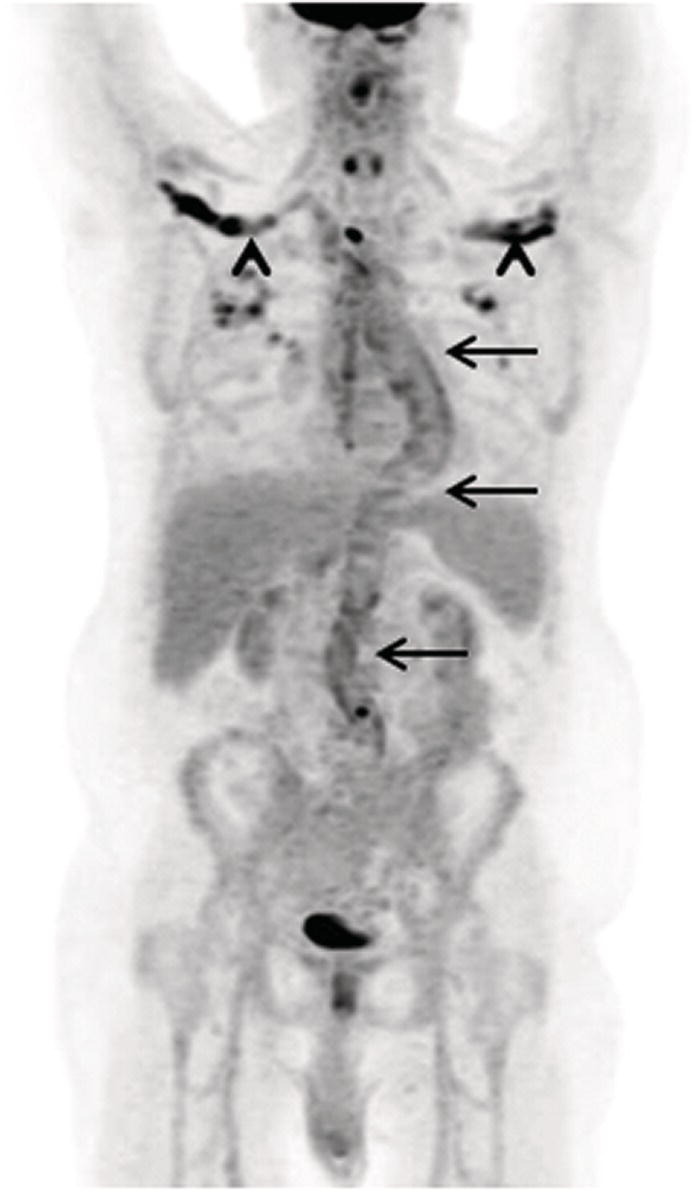 Infection/Inflammation Imaging | Radiology Key