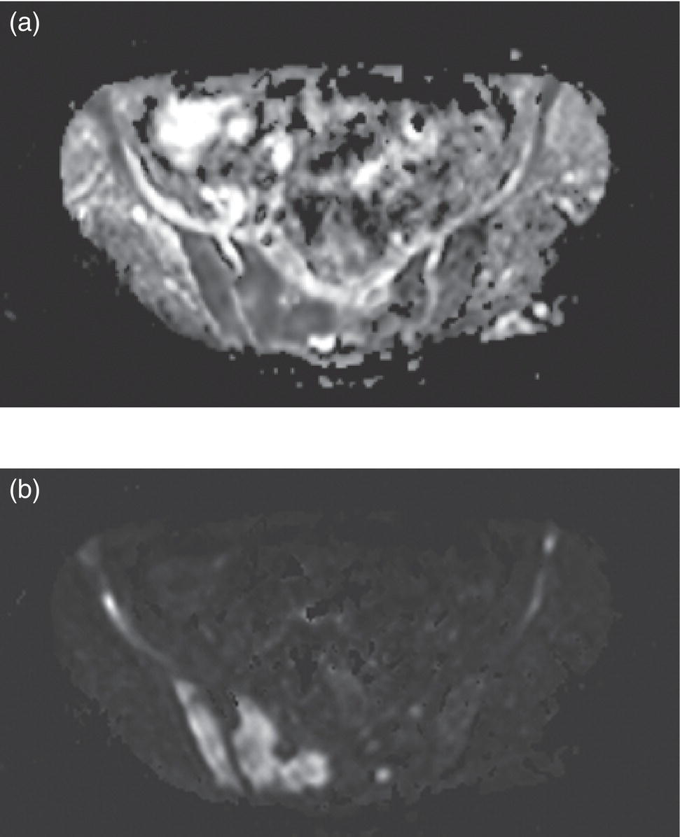 Lymphoma And Myeloma Correlative Imaging | Radiology Key