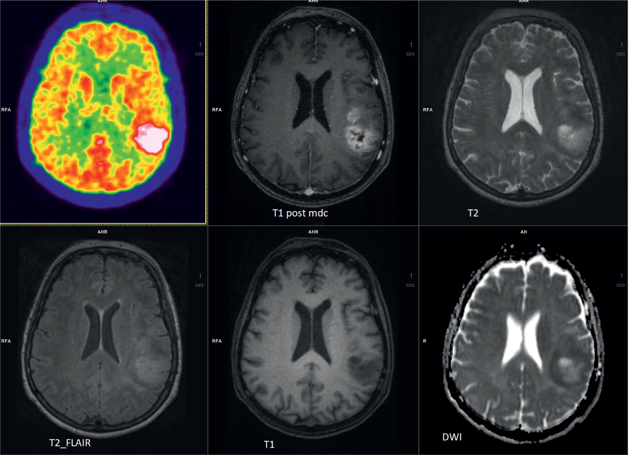 Schematic illustration of 18F-FDG-PET/MRI of an intracranial mass in the left parietal lobe.