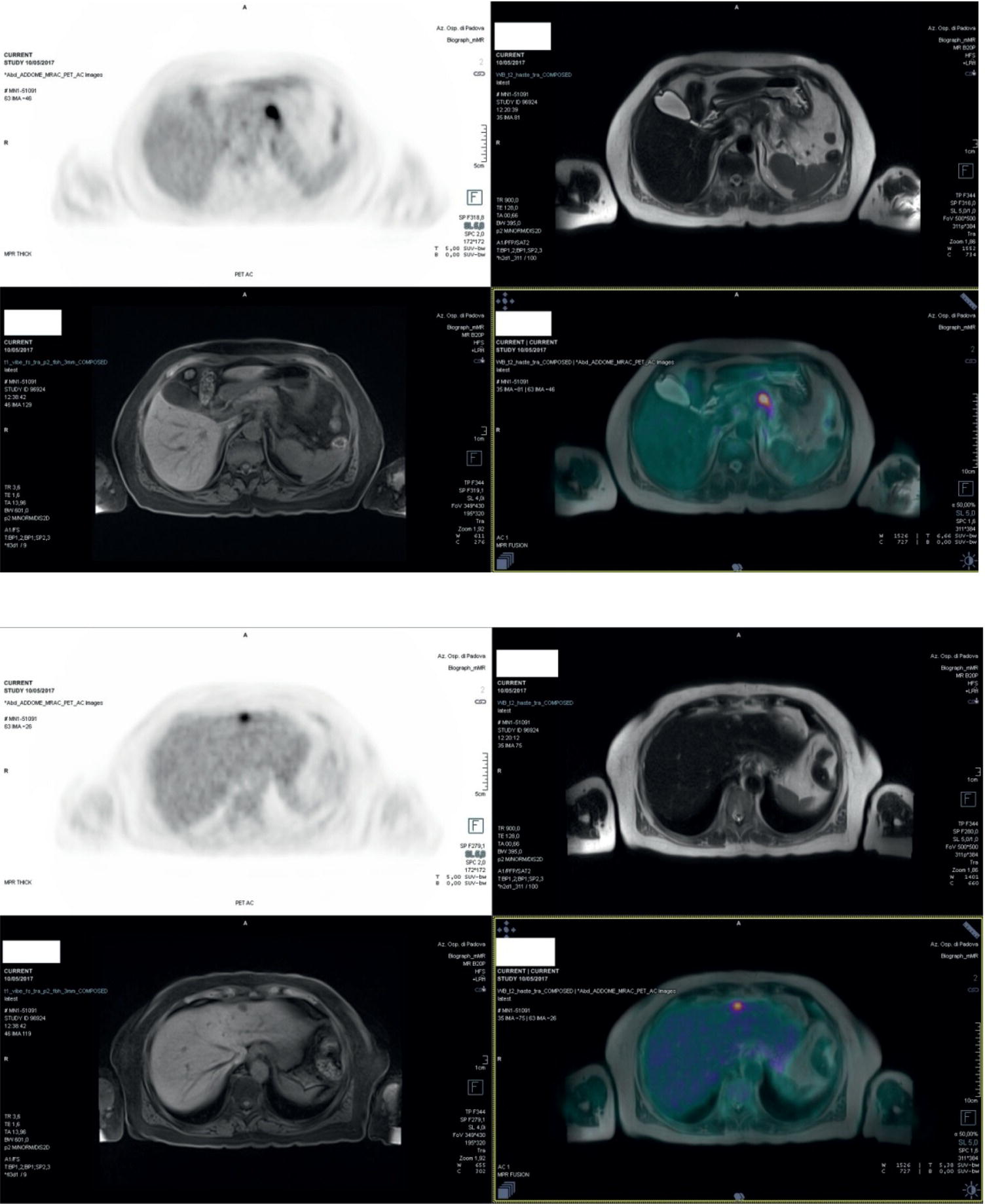 Schematic illustration of 80-year-old woman with a diagnosis of pancreatic ductal adenocarcinoma.