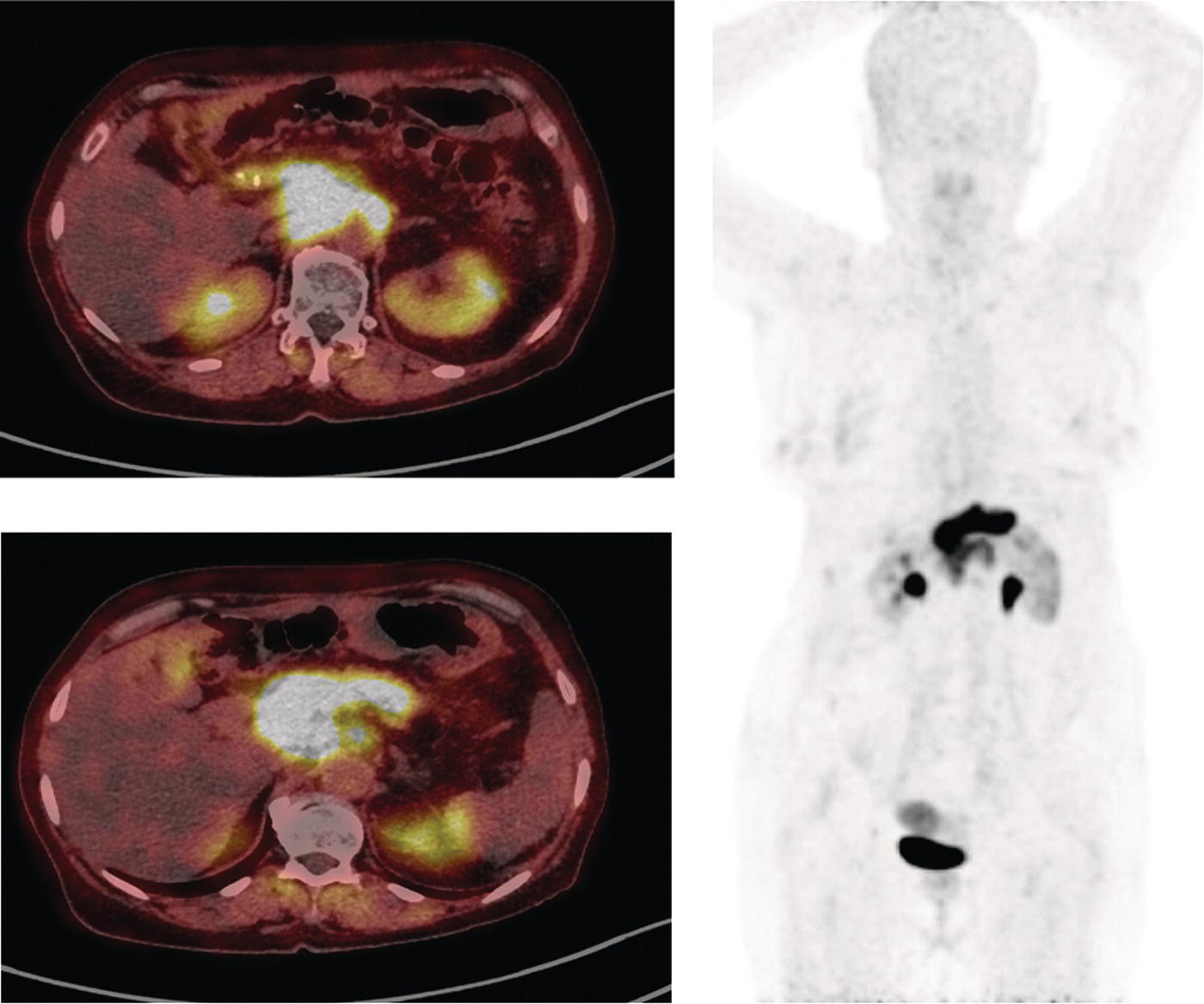 Schematic illustration of a 69-year-old woman with recurrent cholangiocarcinoma underwent 68Ga-FAPI PET/CT.