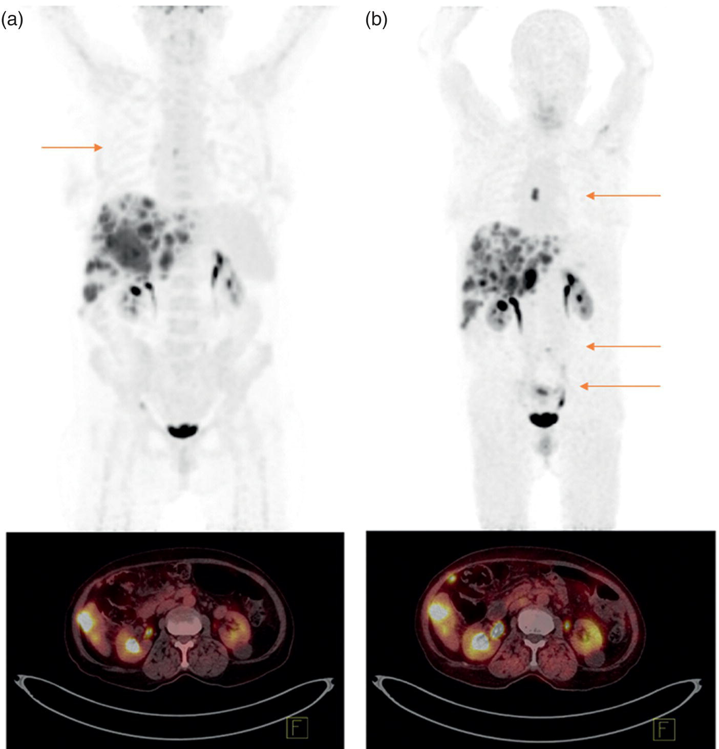 Schematic illustration of a 73-year-old woman with gallbladder adenocarcinoma who underwent cholecystectomy and evidence of progression after chemotherapy.