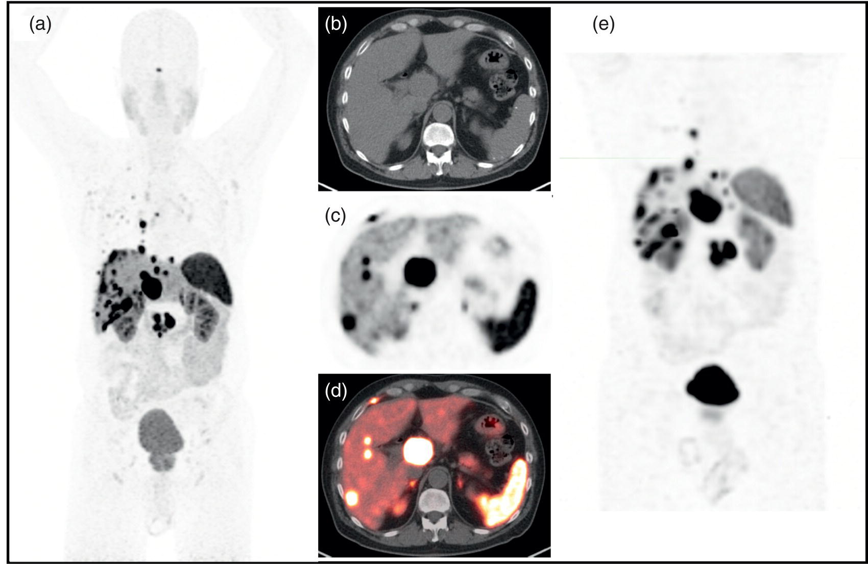 Schematic illustration of 63-year-old male with a pancreatic neuroendocrine neoplasm with liver metastases previously treated with a pancreaticoduodenectomy, adjuvant carboplatin, and liver-directed therapy.