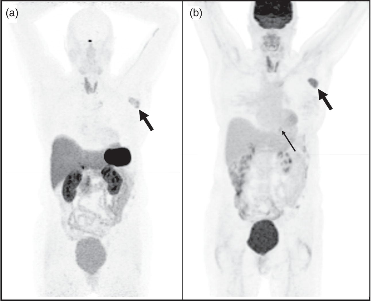 Schematic illustration of 63-year-old female with biopsy proven metastatic right axillary neuroendocrine tumor underwent 68Ga-DOTATATE PET/CT which showed somatostatin receptor expressing (SUVmax 5.9) left axillary lesion (A, thick arrow) and a faintly somatostatin receptor expressing (SUVmax 2.6) soft tissue lesion in the posterior basal segment of the left lung lower lobe (not seen on the maximum intensity projection image).