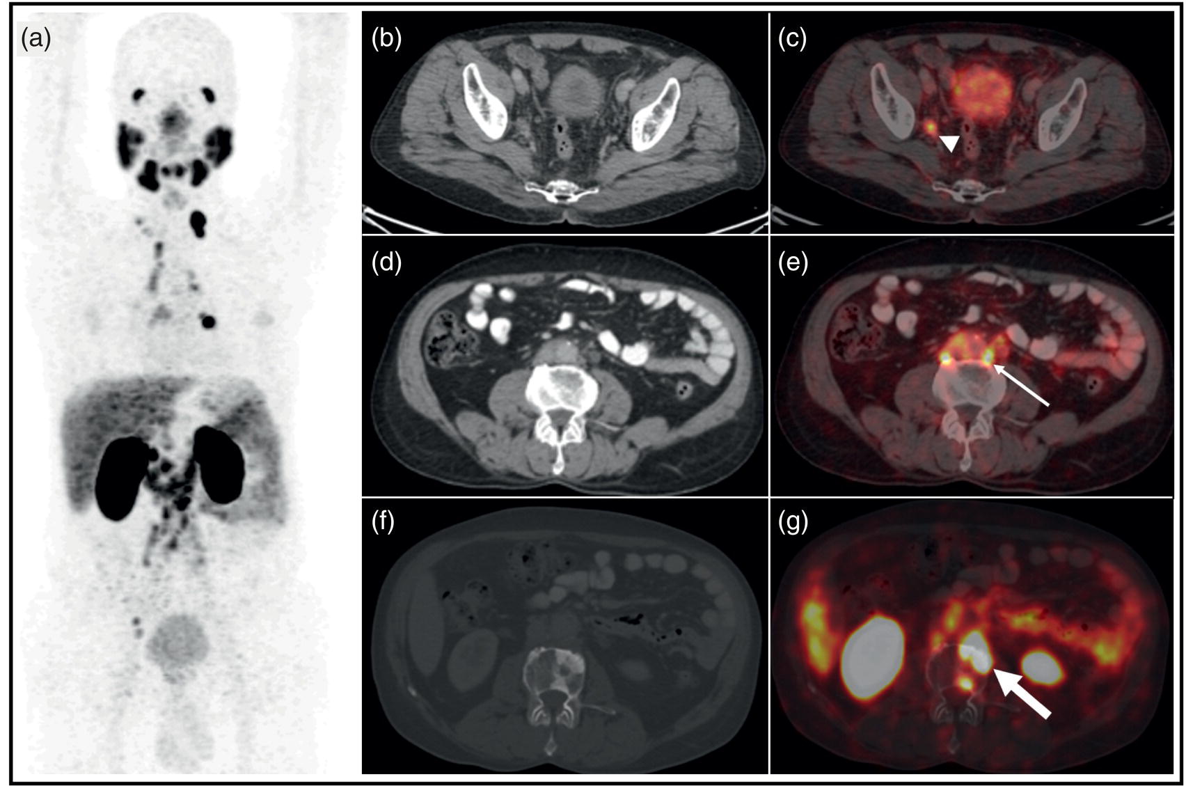 Schematic illustration of 64-year-old male with adenocarcinoma of prostate (Gleason 5 + 4 = 9) post neo-adjuvant hormonal therapy as well as chemotherapy underwent 68Ga-PSMA-11 PET/CT (maximum intensity projection, A) showing multiple PSMA expressing metastases, including nodal (iliac, B, C: arrow-head; para-aortic D, E: thin arrow), pulmonary, and skeletal (F, G, thick arrow).