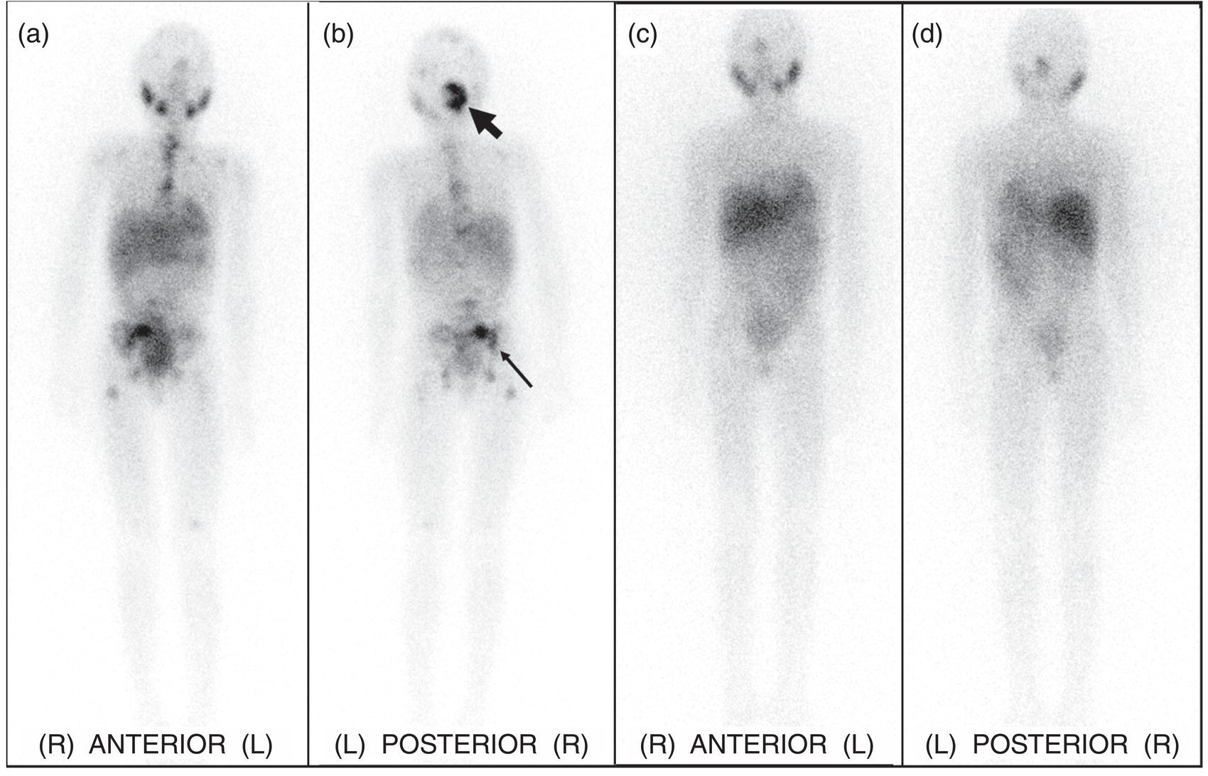 Schematic illustration of eight-year-old female with metastatic left retroperitoneal neuroblastoma treated with multiple therapies, including resection, chemotherapy, external beam radiation, stem cell transplant, and immunotherapy, presented with a left posterior skull mass concerning for recurrent disease.