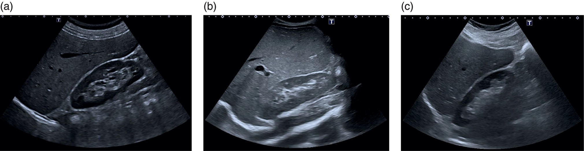 Three ultrasound scan images show a comparison of liver size to the right kidney. a. Size of the right lobe compared to the right kidney. b. Enlarged right liver lobe compared to the cortex of the right kidney. c. The right liver lobe is smaller.