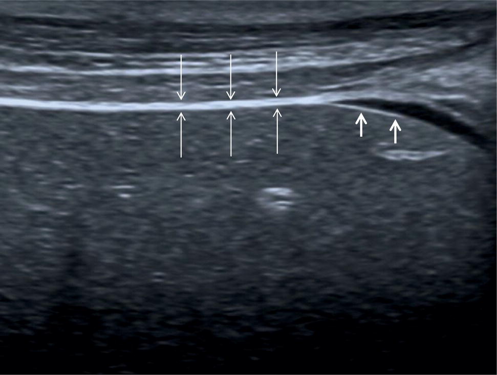 An ultrasound scan image. The liver can barely be seen surrounded by the Glisson’s capsule. It contains three vertically upward-facing arrow marks another three downward-facing arrow marks and two other vertically upward facing arrow marks.