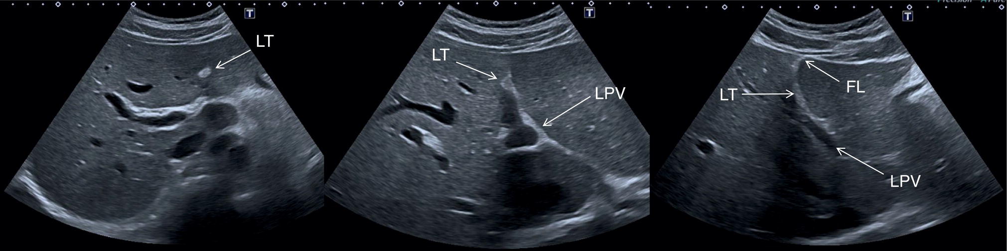 An ultrasound scan image showing three images. 1. The Ligamentum teres is shown. 2. The Ligamentum teres and the left branch of the portal vein are shown. 3. The Ligamentum teres, left branch of the portal vein, and falciform ligament are shown.