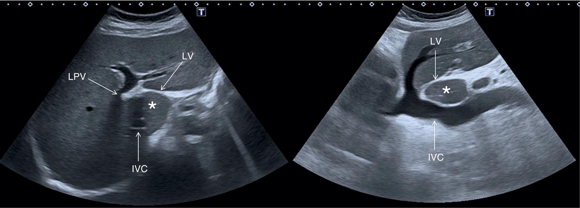 A radiograph image. Two images depict the lower anterior edge of the right liver lobe to segment 4, and it extends the right paracolic space up to the iliac fossa.