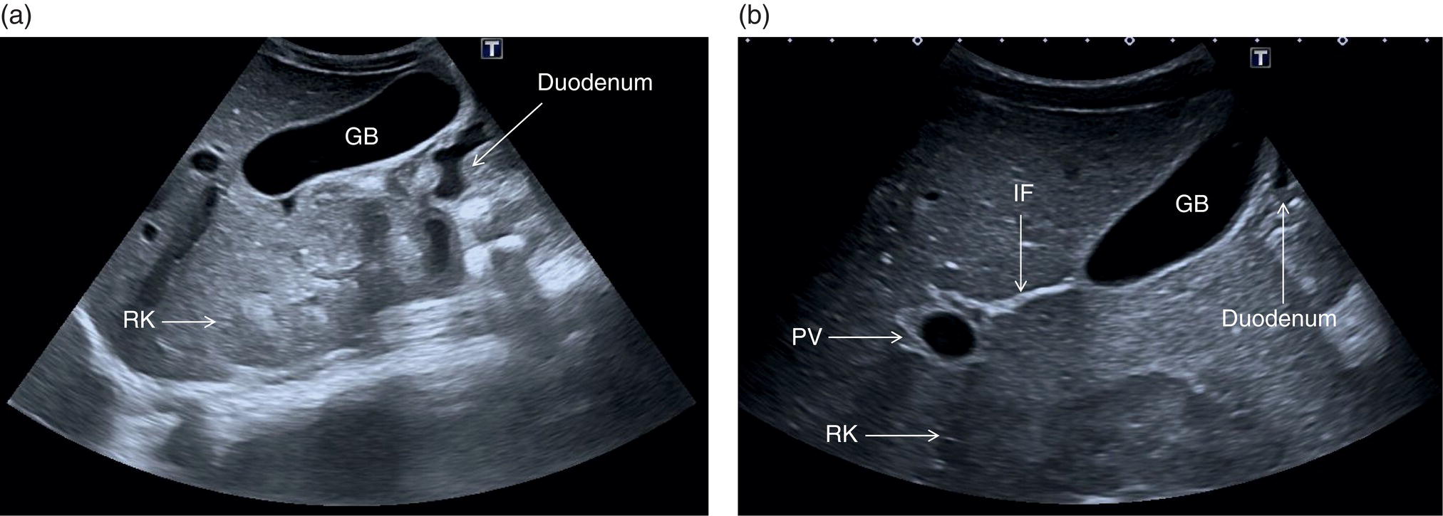 Two ultrasound scan images. 1. The ligamentum venosum, the left branch of the portal vein, and the inferior vena cava are labeled. 2. The ligamentum venosum and inferior vena cava are labeled. The left side image is clear compared to the right.