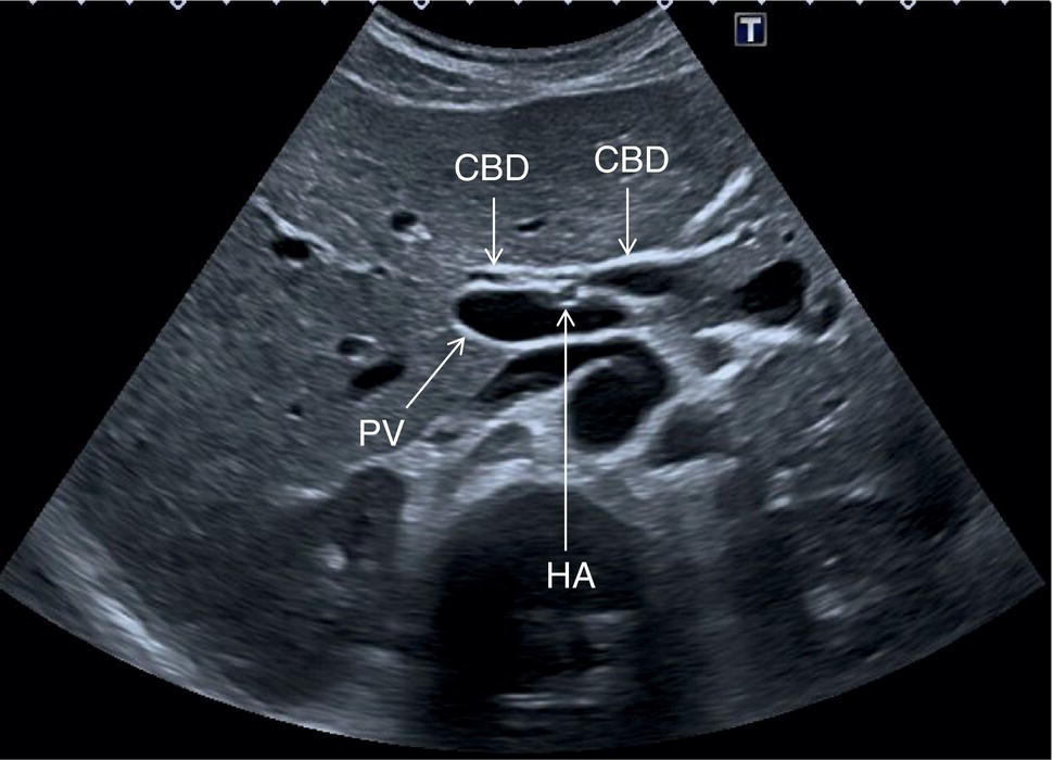 Two ultrasound scan images. a. The gall bladder with duodenum and right kidney are labeled. b. The gall bladder with the duodenum, right kidney, left portal vein, and interlobar fissure are labeled.