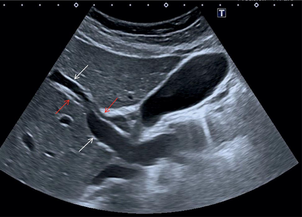 An ultrasound scan image. It depicts two common bile ducts, the portal vein, and the hepatic artery. The hepatic artery is often seen at 
this level in the transverse section.