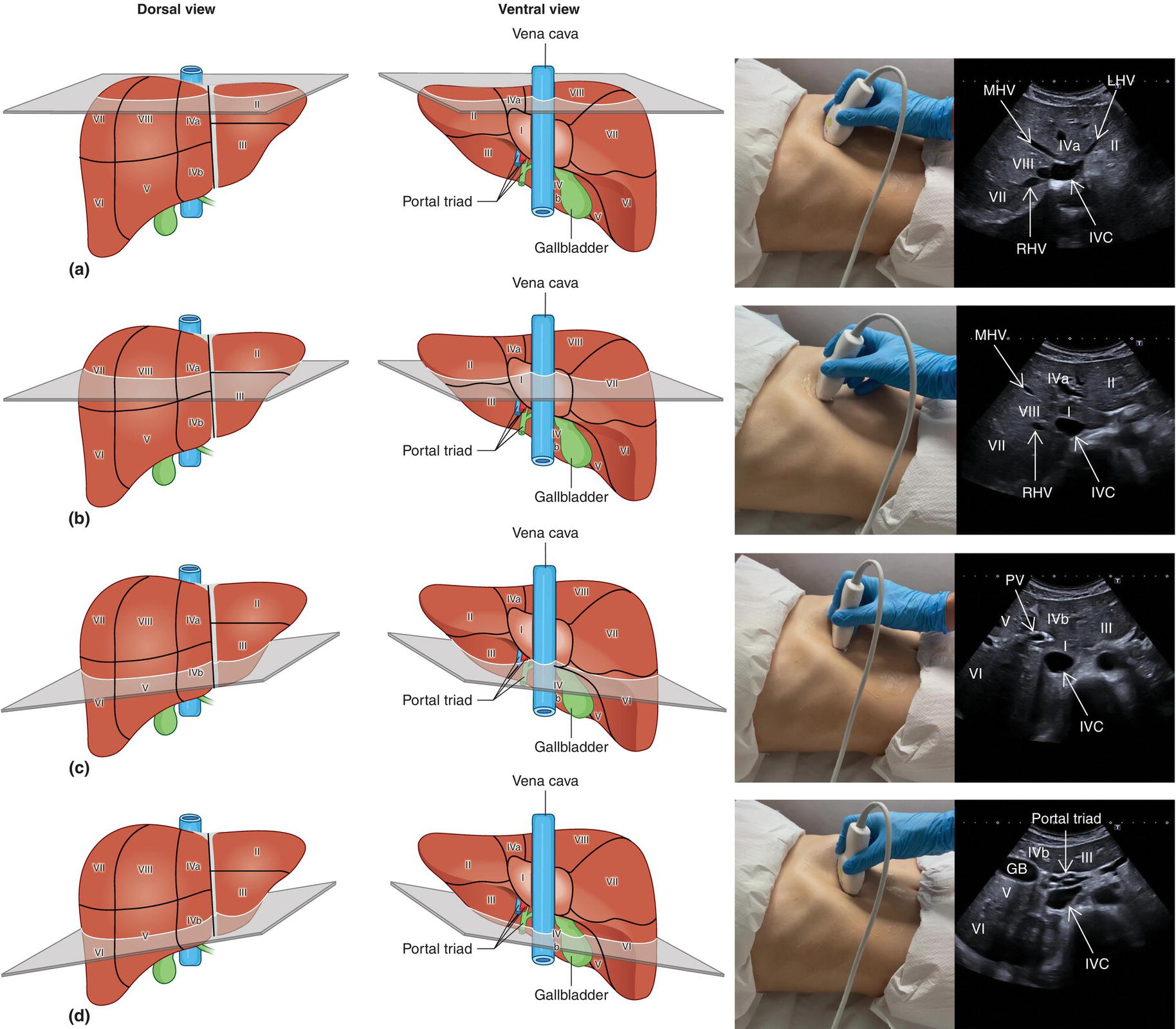 A diagram of liver segmentation. The labeled parts are as follows. I V C, middle, right, left hepatic vein, portal vein, hepatic artery, bile duct, gall bladder, and I V C.