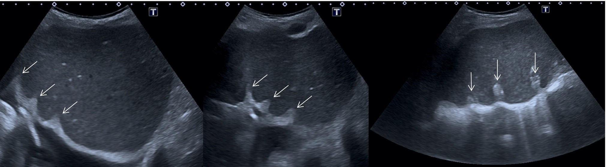 A radiograph. Two images depicting the papillary process in an anterior and medial extension of the caudate lobe of a lymph node are highlighted with an arrow.