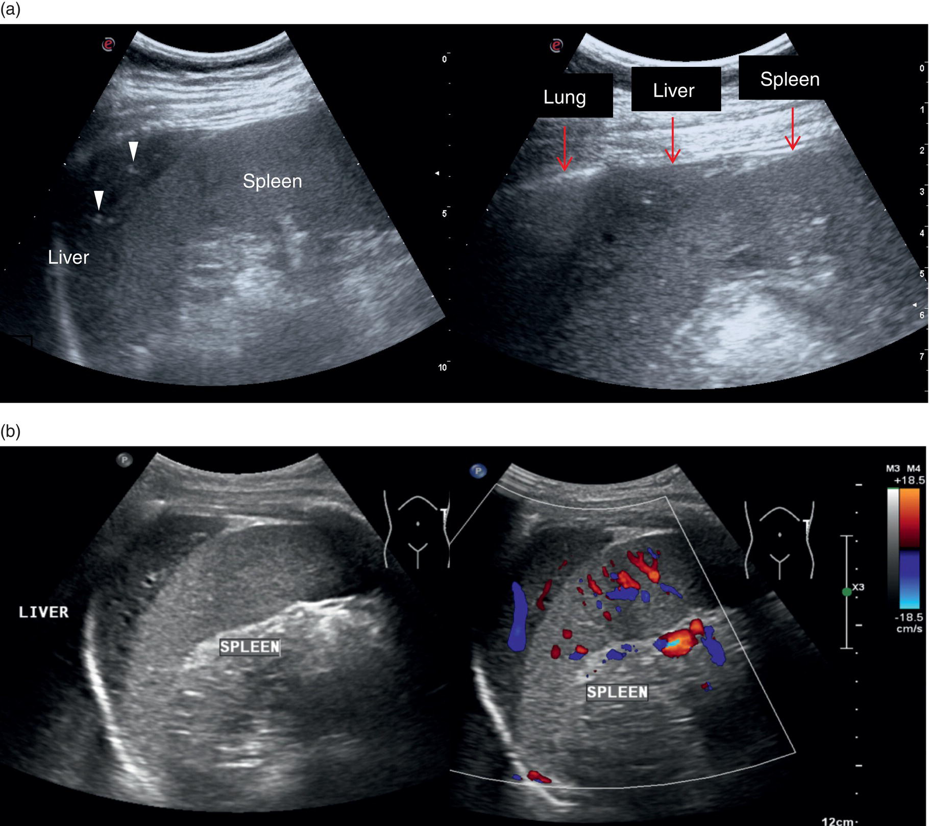A radiograph. Two images depict the hepatic artery, common bile duct, portal vein, and gall bladder are highlighted with arrows.