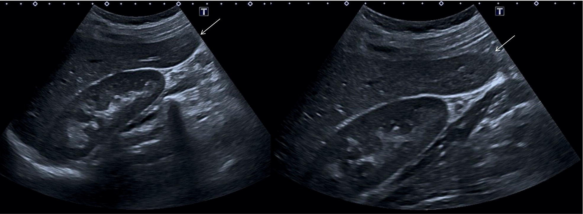 Two photographs and scanned images. The photographs of scanning on the stomach. a. The left hepatic vein, ligamentum venosum, and inferior vena cava in segments 1, 2, 3, and 4. b. Aorta and the segments 2 and 3 are depicted.